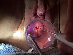 Eletrossondiação dos órgãos genitais raspados com espéculo